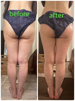 サニー(SUNNY)/キャビテーション痩身コース