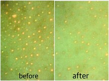 シロ(CHILO)/肌診断の皮脂詰り　ハイドラ施術