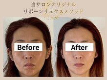 ピュアプラス(Pure Plus)/Before/After