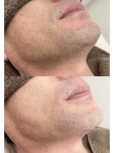 カルディエ(Cardie)/ひげ脱毛　ビフォーアフター