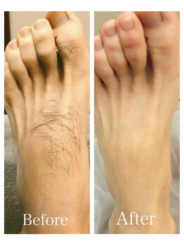 エアリアル 中津店/メンズ足の甲指のムダ毛!