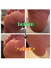 トゥデイム(TODAY'm)/足裏角質ケア