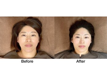 こじま 富雄団地接骨院/ヒト幹細胞美容鍼