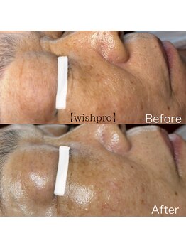 エミナル(EMINALu)/wishppro毛穴