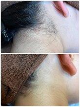 ノノ(nono)/うなじ～えりあし脱毛♪