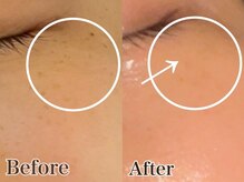 いやしの家さくら/シミケアのビフォーアフター