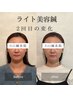 before after sns掲載キャンペーン　　3回分（ライト美容鍼）