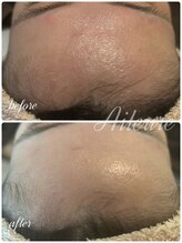 エルール トータルビューティ(Aileure total beauty)/肌を育てるピーリングララピール