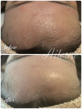 エルール トータルビューティ(Aileure total beauty)/肌を育てるピーリングララピール