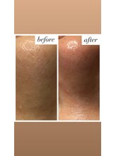 サロン ド マーシャ(salon de Marsha)/毛穴ごっそりケア