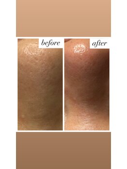 サロン ド マーシャ(salon de Marsha)/毛穴ごっそりケア