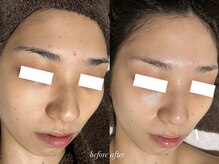 ティアラッシュ(TiaLash)/REVI陶肌トリートメント