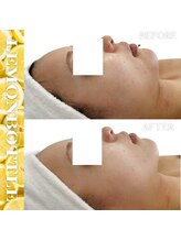 リアム(LiAm)/脂肪分解剤《レモンボトル》