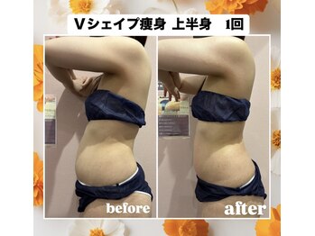 ルピナス ヒサヤ(LUPINUS hisaya)/Vシェイプ痩身