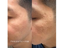 サラシック(salachic)の雰囲気（【新】プロセルセラピーズ/ヒト骨髄幹細胞美容液で肌改善）
