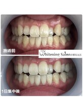 ホワイトニングサロン 京都烏丸店/ホワイトニング瀬術例