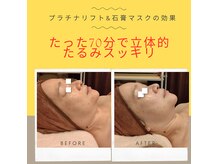 アンジュ(Anju)の雰囲気(乳酸ピール美白リフト+石膏マスク(50代/施術直後)悩み/たるみ)