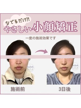 スイッチ(Switch)/なでるだけの小顔矯正なんですが