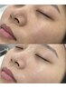 おすすめ［毛穴洗浄＆美白保湿ケア］ツヤ、ツルツル、水光側へ