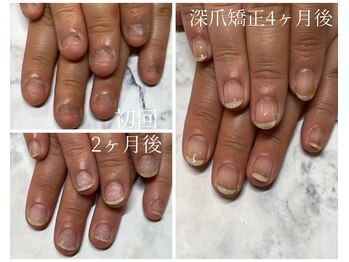 深爪矯正beforeafter