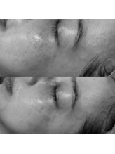 サロンドエー 帝塚山(Salon de A)/シミケアでお悩みの方！