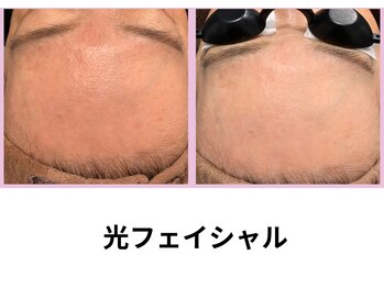 シェリール(Cherir)/光フェイシャル