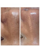 クリア 栄生(CLEAR)/角質除去で毛穴縮小♪