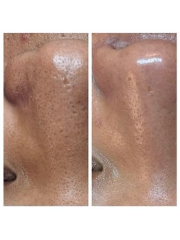 クリア 栄生(CLEAR)/角質除去で毛穴縮小♪