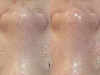 ビーマジック(Be Magic)/乾燥撃退 毛穴洗浄!