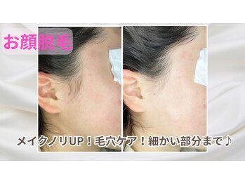 ヴィ シェーン(Vi Schoen)の写真/顔の産毛もスッキリ！細かい所までキレイに整えます♪2回目以降も通いやすい価格設定で、理想の素肌へ◎