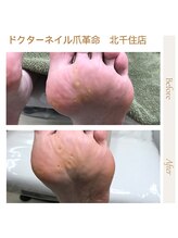 ドクターネイル爪革命 北千住店/たこ、うおのめケア　