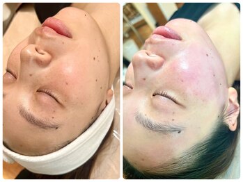 シシエル(CHICIEL)/フェイシャルワックスで発光肌