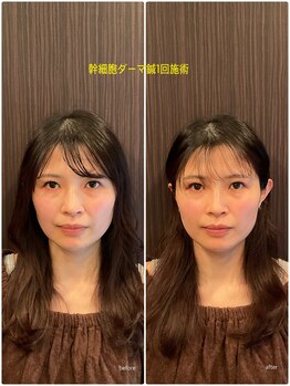 はる鍼灸整骨院/30代女性｜1回の結果