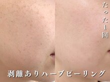 ダリア(Dahlia)/剥離ありハーブピーリング