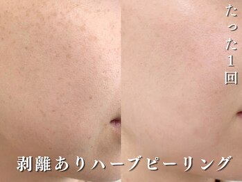 ダリア(Dahlia)/剥離ありハーブピーリング