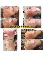 ビエル(Bielle)&nbsp;ニキビ赤跡ザラつき原因不明の赤み茶色跡3ヶ月改善プログラム