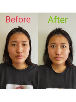 シャルム(Charme)/小顔矯正＋全身美容整体施術１回