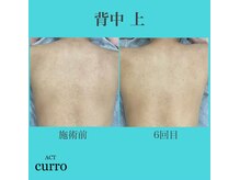 アクト クロ(ACT curro)/【背中上】脱毛施術例