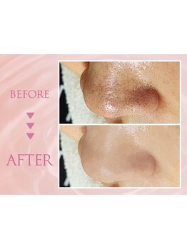 毛穴ケアをしたい