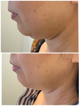 プリュネル(Prunelle)/プラズマシャワー