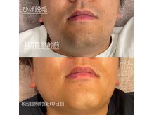 次郎の雰囲気（数少ない男性脱毛士の施術◎勿論施術者も当店脱毛機で全身脱毛済）