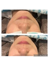 レイモード(Ray mode)/BBLフェイシャル＆バック