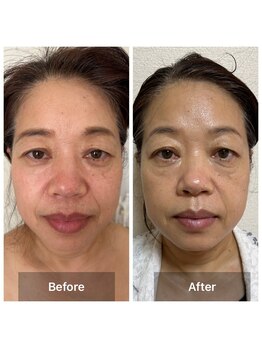 サロン ド アヤ(salon de Aya)/月2回ご来店で５ヶ月の変化