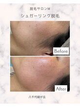 脱毛 ピーリングサロン M/