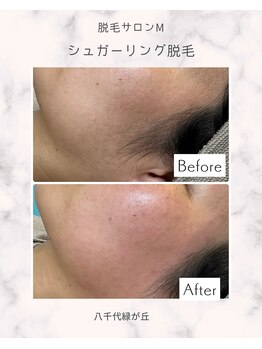脱毛 ピーリングサロン M/