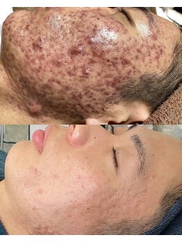 ソリッジ肌管理室/毛穴・ニキビケア