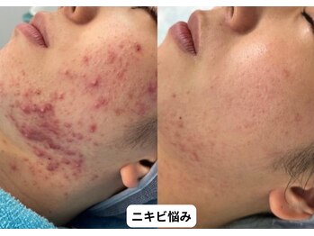 リメイク 銀座(REMAKE)/幹細胞ゴールドピーリング