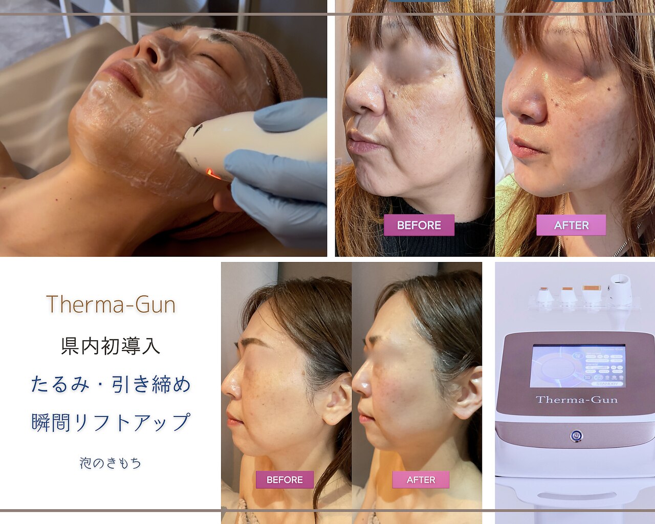 新潟市東区で毛穴洗浄・毛穴吸引が人気のエステサロン｜ホットペッパー