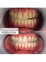 ビューティリュクス(beauty luxe)/笑顔に自信セルフホワイトニング