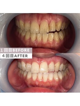 ビューティリュクス(beauty luxe)/笑顔に自信セルフホワイトニング